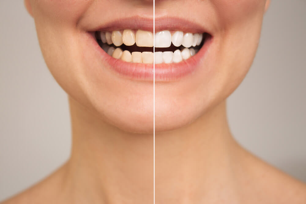 Blanqueamiento dental, recupera el brillo