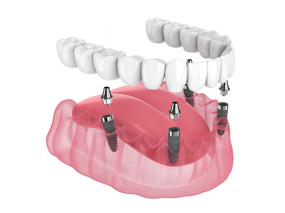Tratamientos de implantes dentales en Costa Rica