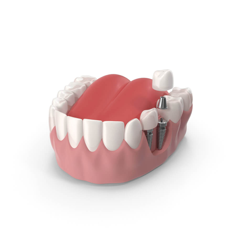 Qué son los implantes dentales