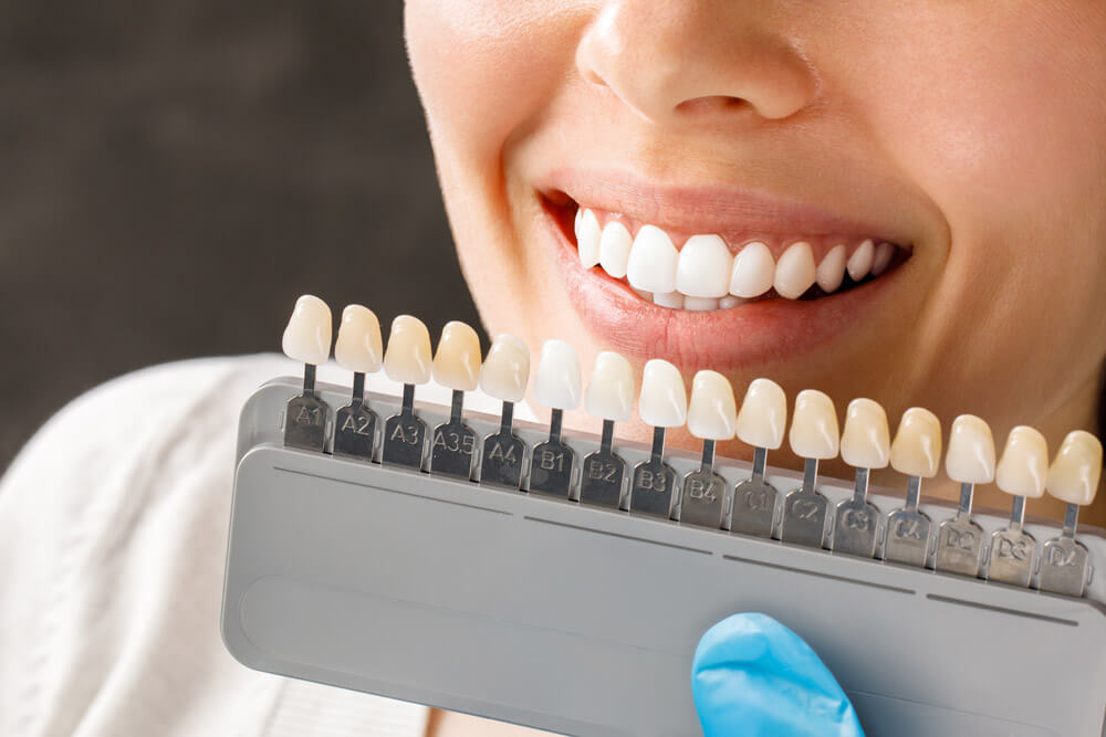Carillas dentales a la medida