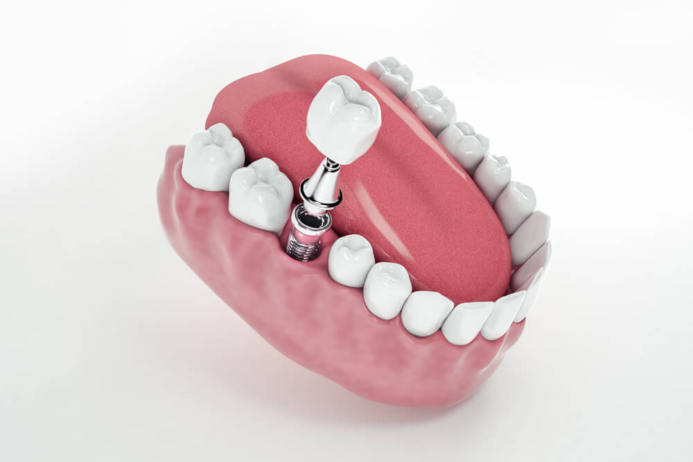 Implantes dentales, recupera tu sonrisa completa