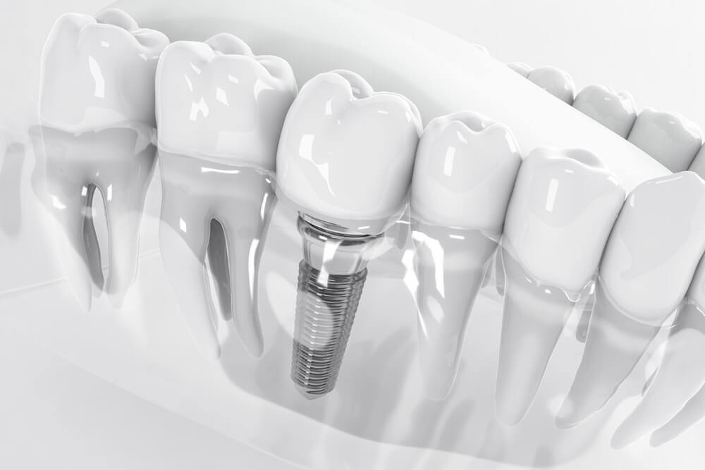 Implantes All-on-4, All-on-6 y All-on-8 Implantes All-on-4: 