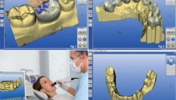 cad-cam-dental-tratamiento-300x241